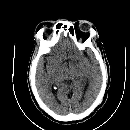 Chronic invasive fungal sinusitis (Radiopaedia 91563-109286 Axial non-contrast 49).jpg