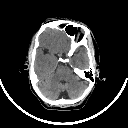 File:Chronic invasive fungal sinusitis with intraorbital and intracranial extension (Radiopaedia 56387-63046 Axial non-contrast 146).jpg