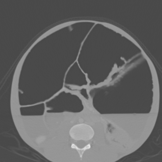 Chronic large bowel pseudo-obstruction (Radiopaedia 43181-46492 Axial bone window 103).jpg