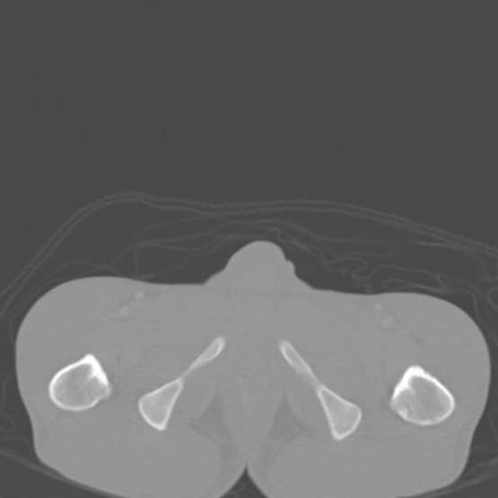 Chronic large bowel pseudo-obstruction (Radiopaedia 43181-46492 Axial bone window 169).jpg