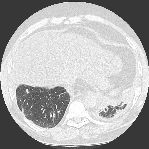 Chronic lung allograft dysfunction - restrictive form (Radiopaedia 60595-68316 Axial lung window 57).jpg