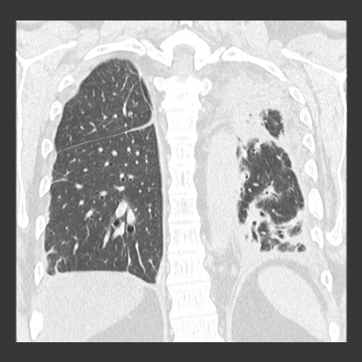 Chronic lung allograft dysfunction - restrictive form (Radiopaedia 60595-68316 Coronal lung window 72).jpg