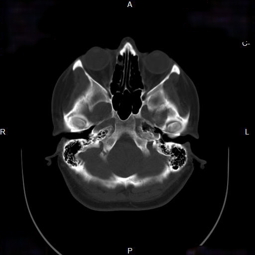 File:Chronic maxillary sinusitis with a foreign body (dental filling material) (Radiopaedia 7811-8639 Axial bone window 10).jpg