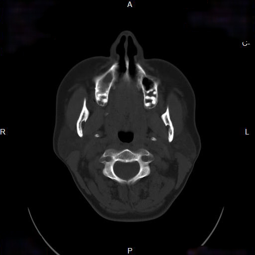 File:Chronic maxillary sinusitis with a foreign body (dental filling material) (Radiopaedia 7811-8639 Axial bone window 2).jpg