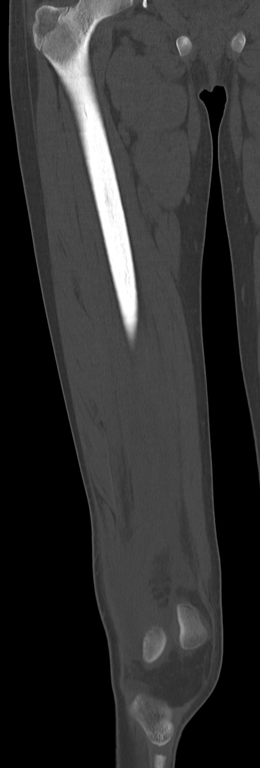 Chronic ostemyelitis of the femur with long sinus tract (Radiopaedia 74947-85982 Coronal bone window 33).jpg