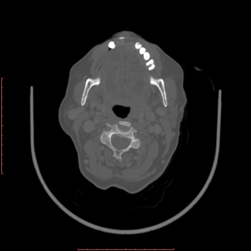 Chronic osteomyelitis - maxilla (Radiopaedia 23783-23927 Axial bone window 44).jpg