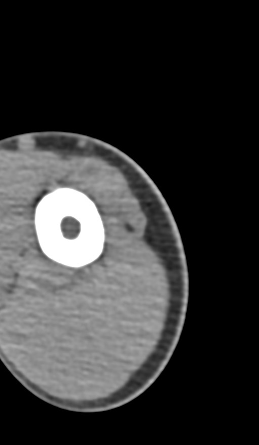 Chronic osteomyelitis of the distal humerus (Radiopaedia 78351-90971 Axial non-contrast 17).jpg