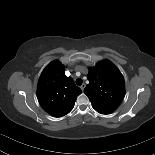 Chronic pulmonary embolus (Radiopaedia 39129-41341 Axial C+ CTPA 26).png