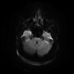 Chronic submandibular sialadenitis (Radiopaedia 61852-69885 Axial DWI 2).jpg