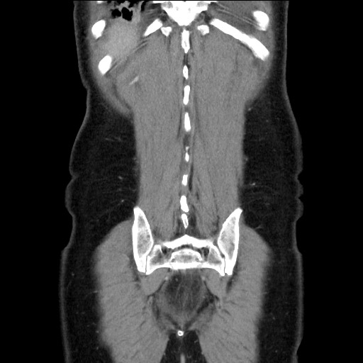 Chronic ureteropelvic junction obstruction (Radiopaedia 78365-90996 B 88).jpg