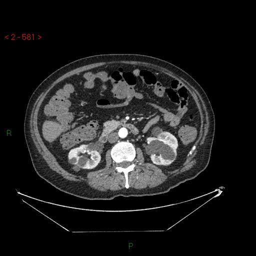 Circumaortic left renal vein and doubled left renal arteries (Radiopaedia 52268-58158 A 117).jpg