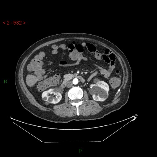 File:Circumaortic left renal vein and doubled left renal arteries (Radiopaedia 52268-58158 A 118).jpg