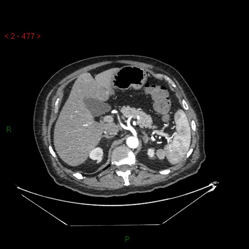 File:Circumaortic left renal vein and doubled left renal arteries (Radiopaedia 52268-58158 A 13).jpg