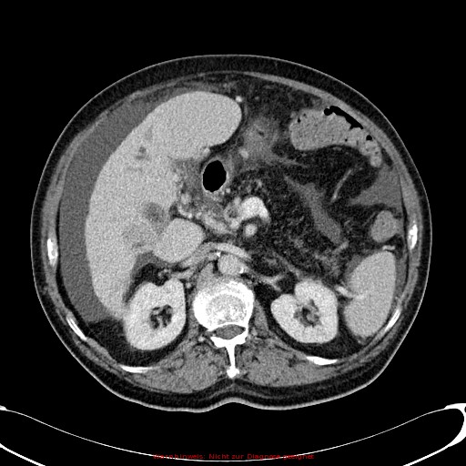 Cirrhosis and hepatocellular carcinoma in the setting of hemochromatosis (Radiopaedia 75394-86595 B 35).jpg
