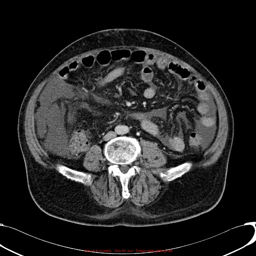 File:Cirrhosis and hepatocellular carcinoma in the setting of hemochromatosis (Radiopaedia 75394-86595 B 54).jpg