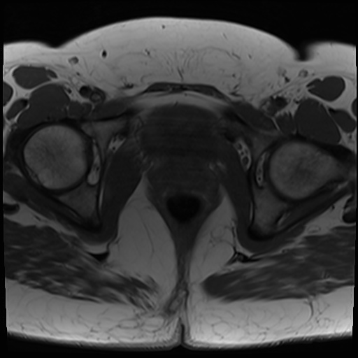 File:Class II Mullerian duct anomaly- unicornuate uterus with rudimentary horn and non-communicating cavity (Radiopaedia 39441-41755 Axial T1 23).jpg