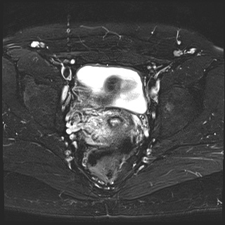 File:Class II Mullerian duct anomaly- unicornuate uterus with rudimentary horn and non-communicating cavity (Radiopaedia 39441-41755 Axial T2 fat sat 18).jpg