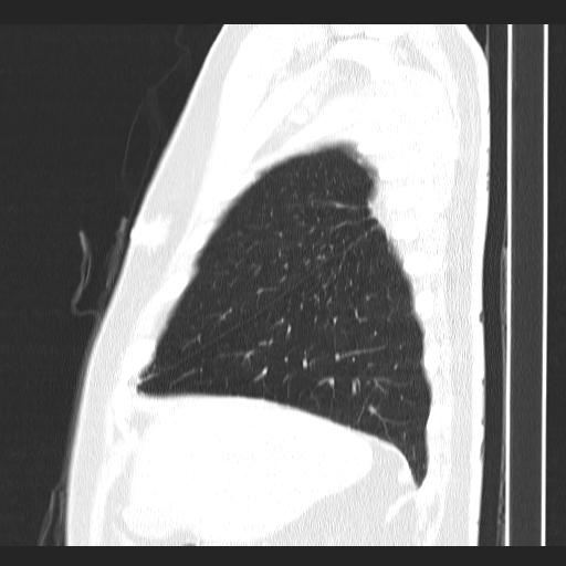 Classic complicated silicosis (Radiopaedia 49720-54961 Sagittal lung window 52).jpg