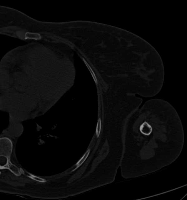 Clear cell chondrosarcoma - humerus (Radiopaedia 63104-71612 Axial bone window 101).jpg