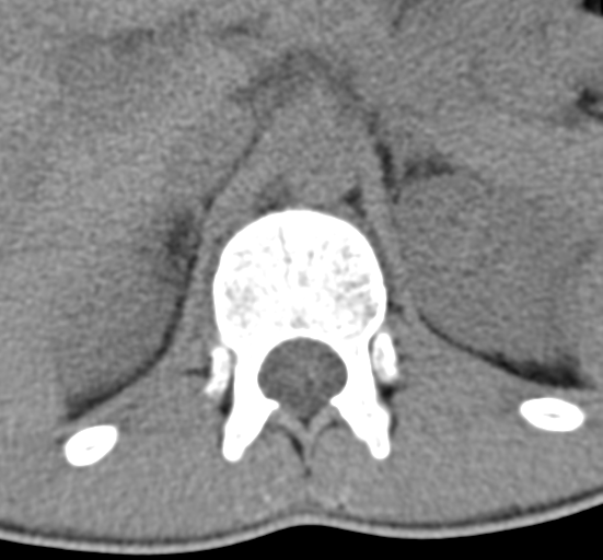 File:Clear cell meningoma - lumbar spine (Radiopaedia 60116-67691 Axial non-contrast 2).png