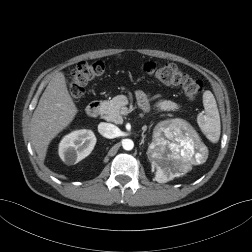 File:Clear cell renal cell carcinoma (Radiopaedia 61449-69393 B 26).jpg