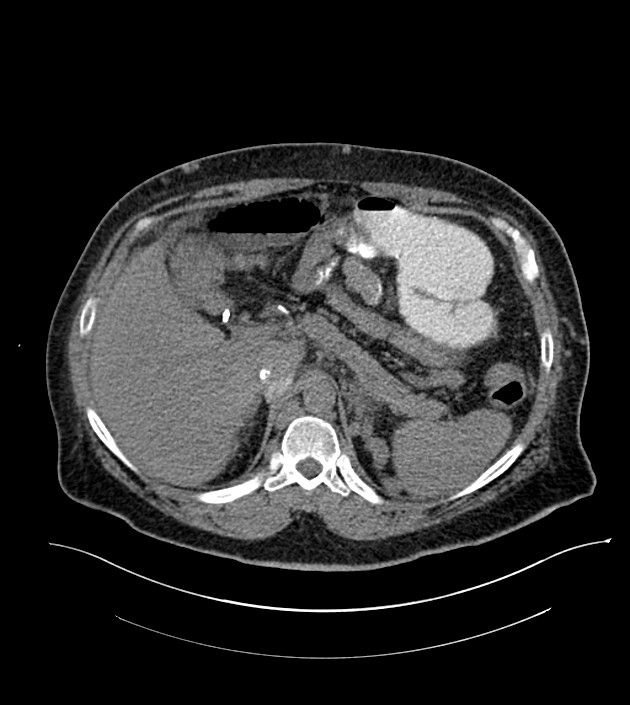 Closed-loop small bowel obstruction-internal hernia (Radiopaedia 78439-91096 Axial non-contrast 41).jpg