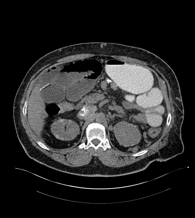Closed-loop small bowel obstruction-internal hernia (Radiopaedia 78439-91096 Axial non-contrast 52).jpg