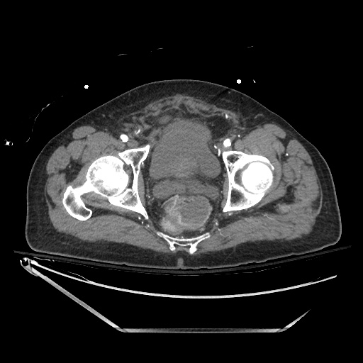File:Closed loop obstruction due to adhesive band, resulting in small bowel ischemia and resection (Radiopaedia 83835-99023 B 143).jpg