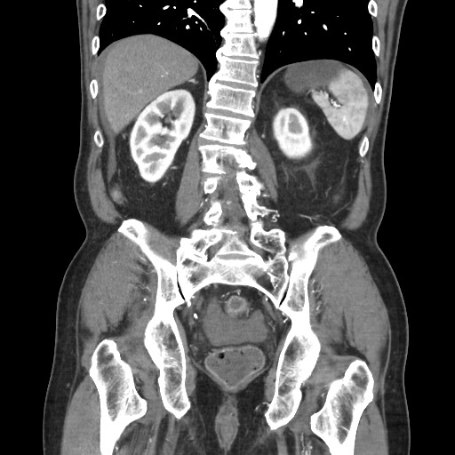 Closed loop obstruction due to adhesive band, resulting in small bowel ischemia and resection (Radiopaedia 83835-99023 C 88).jpg