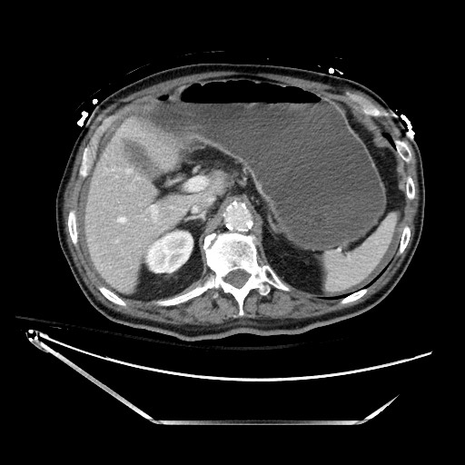 File:Closed loop obstruction due to adhesive band, resulting in small bowel ischemia and resection (Radiopaedia 83835-99023 D 44).jpg