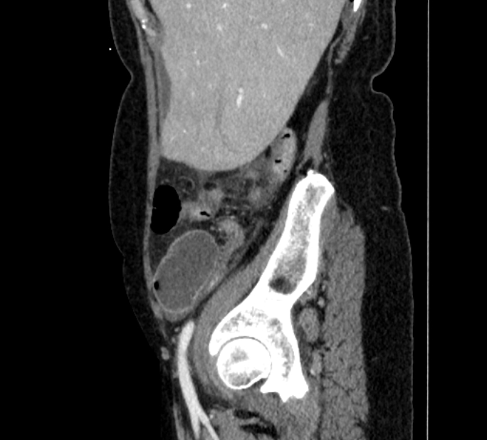 Closed loop small bowel obstruction (Radiopaedia 71211-81508 C 15).jpg