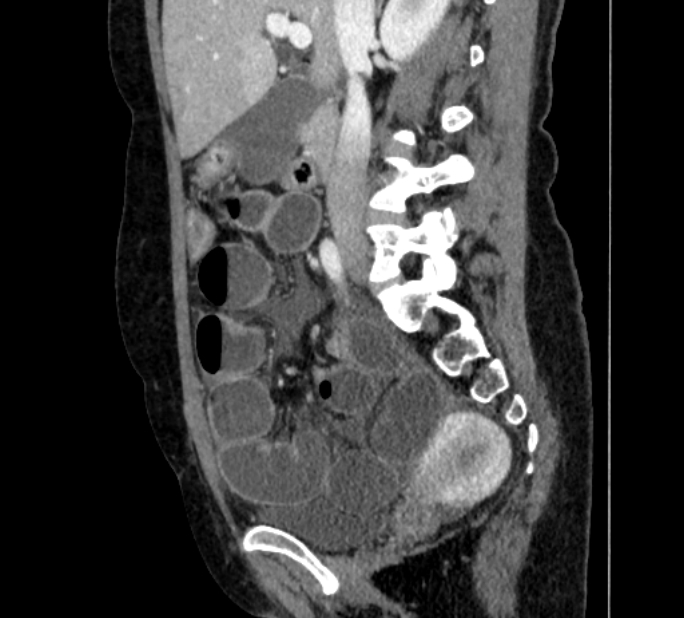 Closed loop small bowel obstruction (Radiopaedia 71211-81508 C 57).jpg
