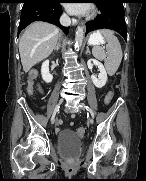Closed loop small bowel obstruction - adhesions (Radiopaedia 59269-66611 B 72).jpg