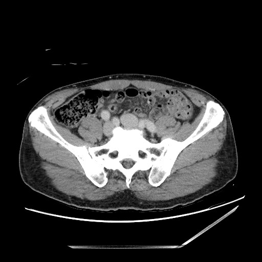 File:Closed loop small bowel obstruction - omental adhesion causing "internal hernia" (Radiopaedia 85129-100682 A 122).jpg