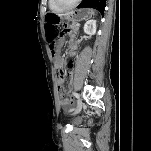 Closed loop small bowel obstruction - omental adhesion causing "internal hernia" (Radiopaedia 85129-100682 C 115).jpg