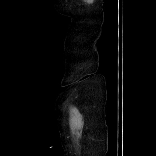 Closed loop small bowel obstruction due to adhesive band, with intramural hemorrhage and ischemia (Radiopaedia 83831-99017 D 32).jpg
