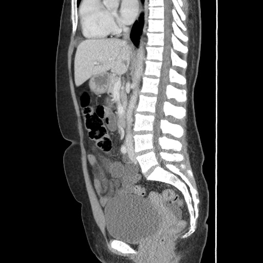 File:Closed loop small bowel obstruction due to trans-omental herniation (Radiopaedia 35593-37109 C 34).jpg