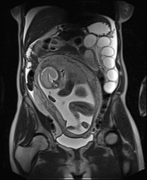File:Closed loop small bowel obstruction in pregnancy (MRI) (Radiopaedia 87637-104031 Coronal T2 28).jpg