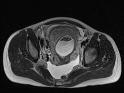 Closed loop small bowel obstruction in pregnancy (MRI) (Radiopaedia 87637-104031 D 30).jpg