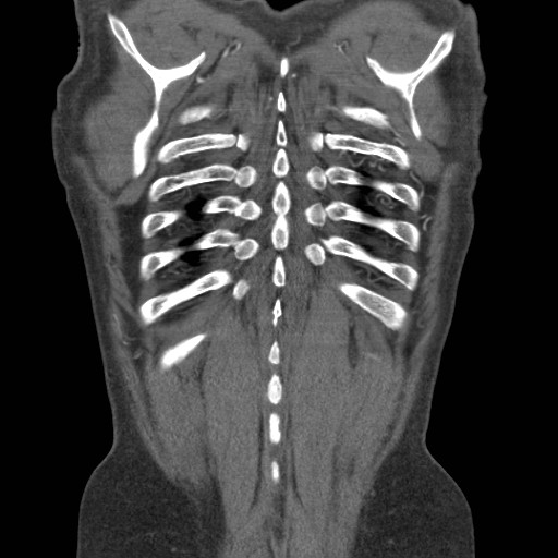 Coarctation of the aorta (Radiopaedia 17427-17116 A 12).jpg