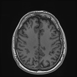 Cochlear incomplete partition type III associated with hypothalamic hamartoma (Radiopaedia 88756-105498 Axial T1 135).jpg