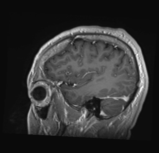File:Cochlear incomplete partition type III associated with hypothalamic hamartoma (Radiopaedia 88756-105498 Sagittal T1 C+ 13).jpg