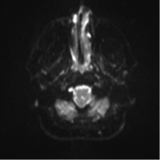File:Colloid cyst (Radiopaedia 44510-48181 Axial DWI 3).png