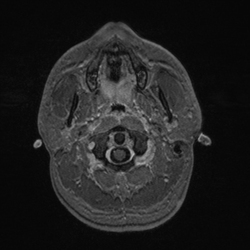 Colloid cyst (Radiopaedia 44510-48181 Axial T1 C+ 17).png
