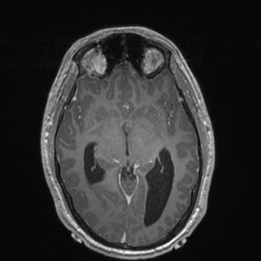 File:Colloid cyst (Radiopaedia 44510-48181 Axial T1 C+ 84).png