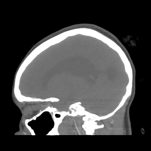 File:Colloid cyst (resulting in death) (Radiopaedia 33423-34499 B 36).png
