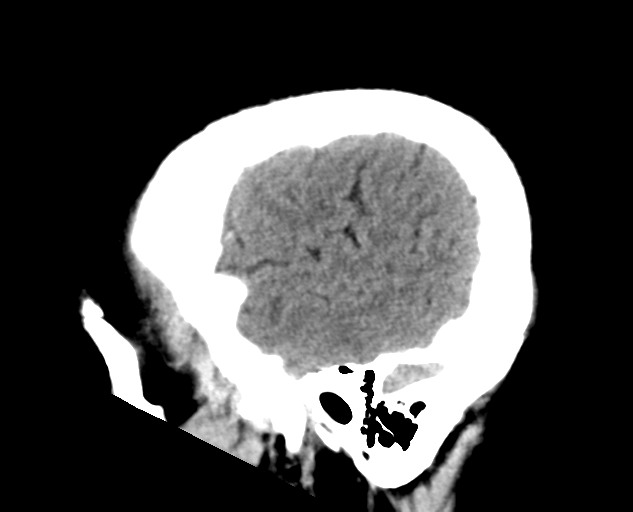 File:Colloid cyst of the third ventricle (Radiopaedia 86571-102661 B 28).png
