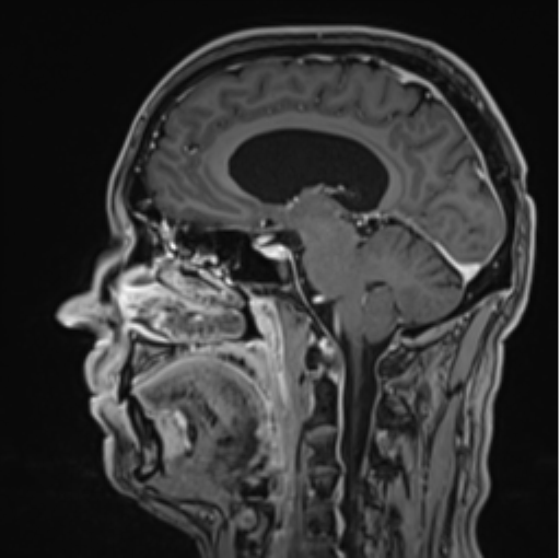 File:Colloid cyst of the third ventricle (Radiopaedia 86571-102662 Sagittal T1 C+ 36).png