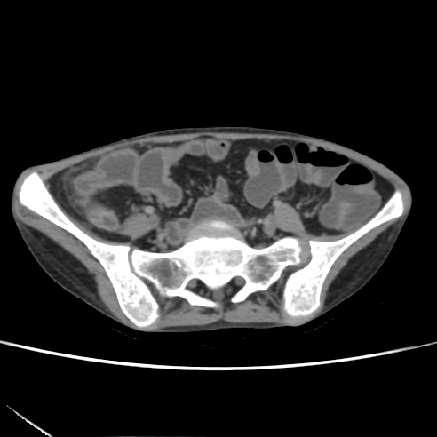 File:Colocolic fistula - Crohn disease (Radiopaedia 57063-63955 A 62).jpg