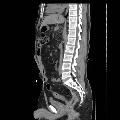 File:Colocutaneous fistula in Crohn's disease (Radiopaedia 29586-30093 C 22).jpg